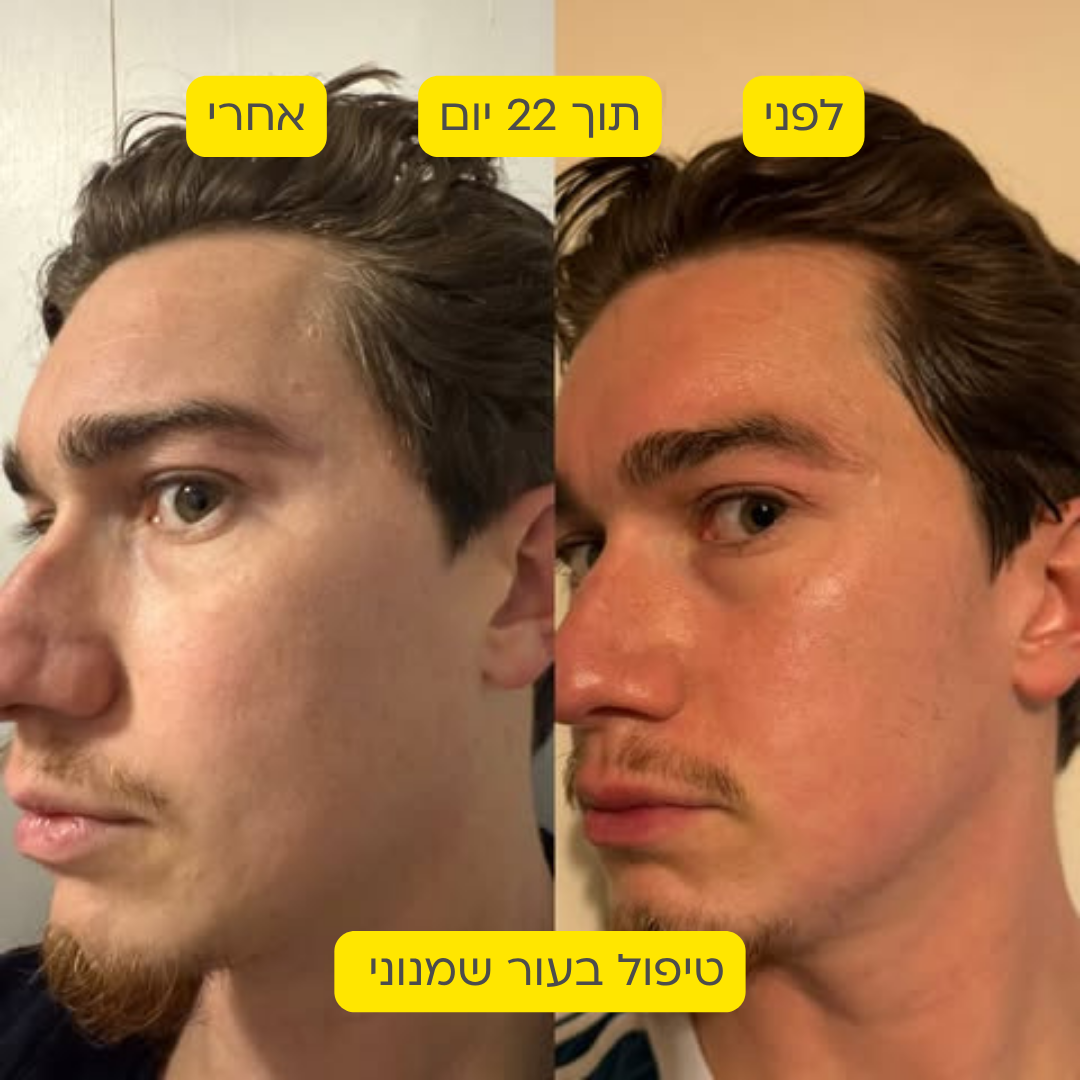 לפני אחרי 6