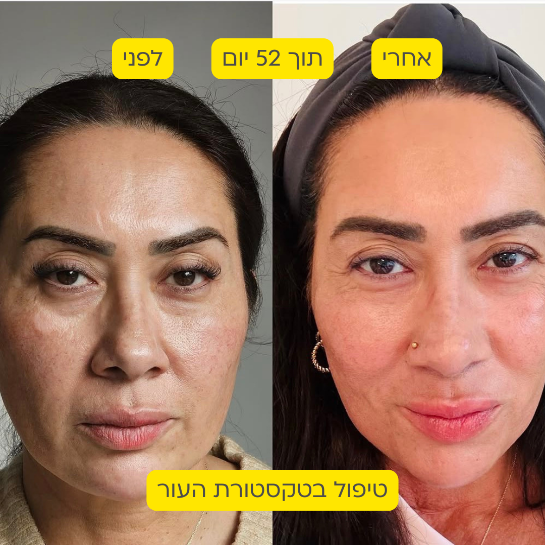 לפני אחרי 4