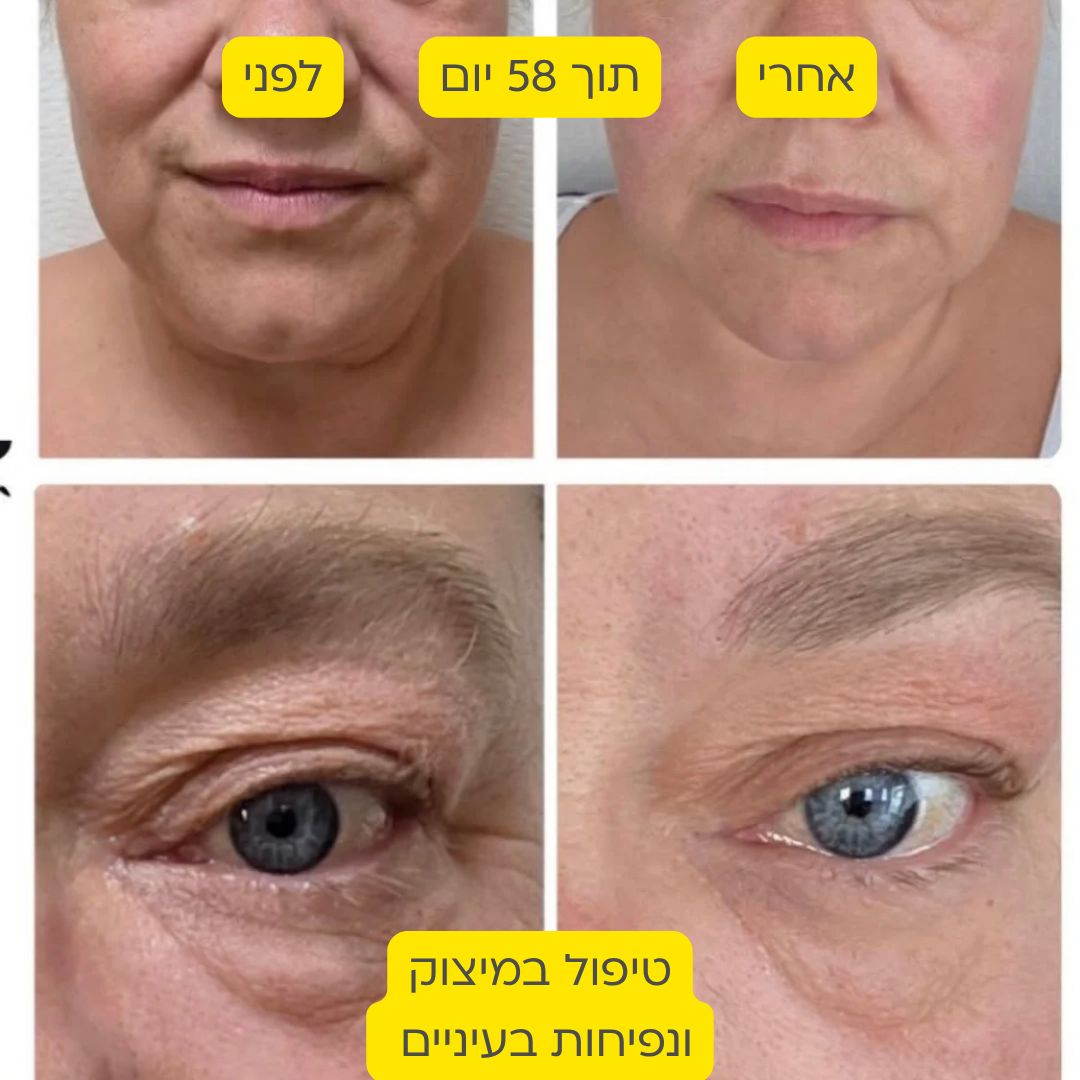 לפני אחרי 5