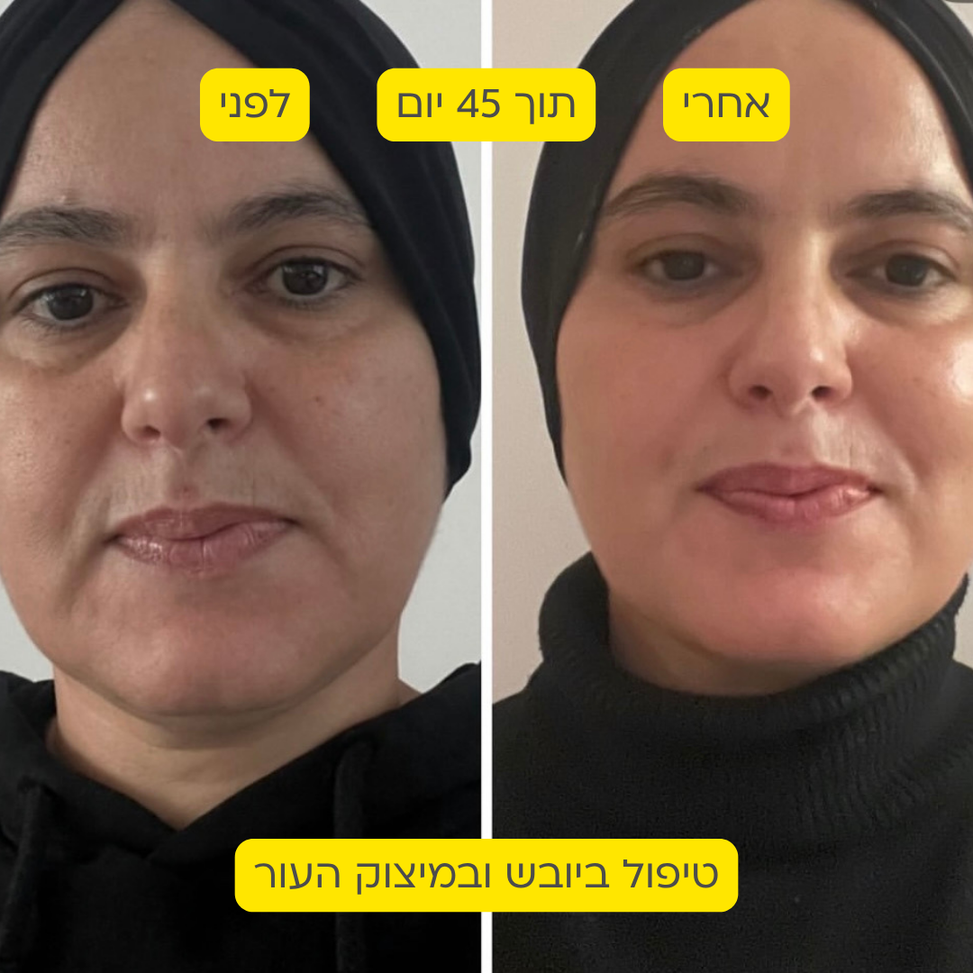 לפני אחרי 12