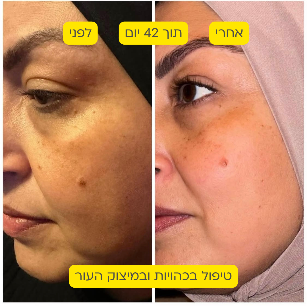 לפני אחרי 10