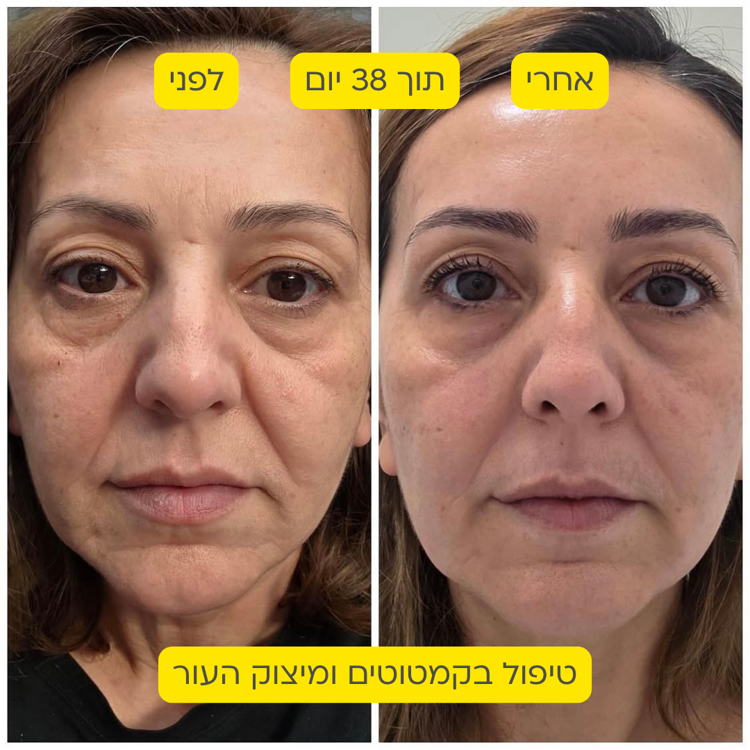 לפני אחרי 9