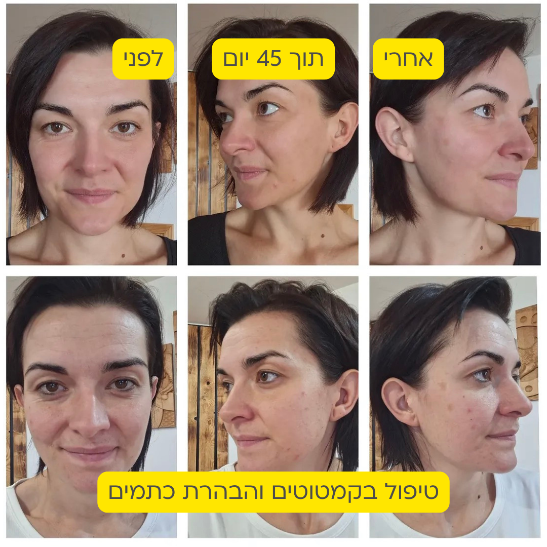 לפני אחרי 8
