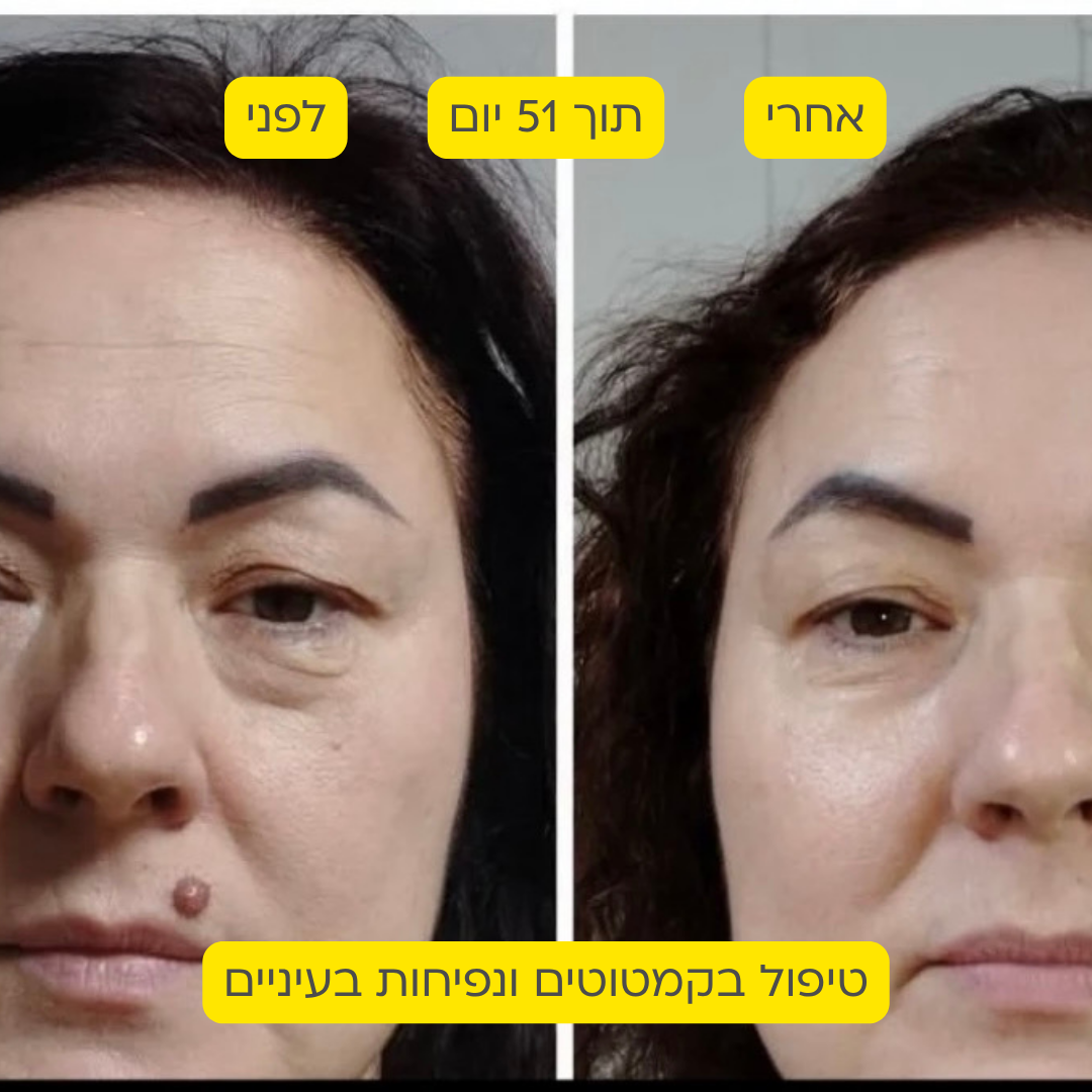 לפני אחרי 7