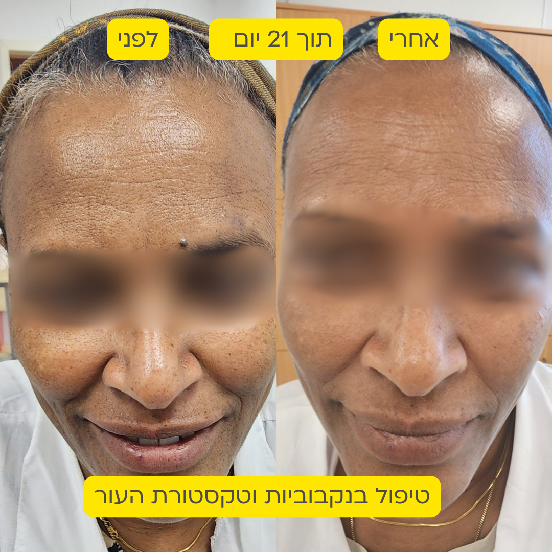 לפני אחרי 2