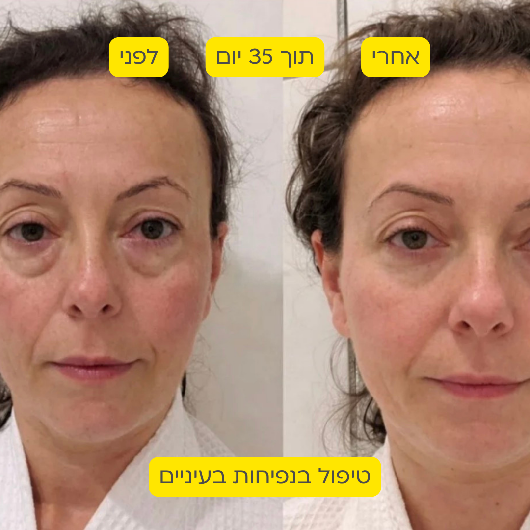 לפני אחרי 17