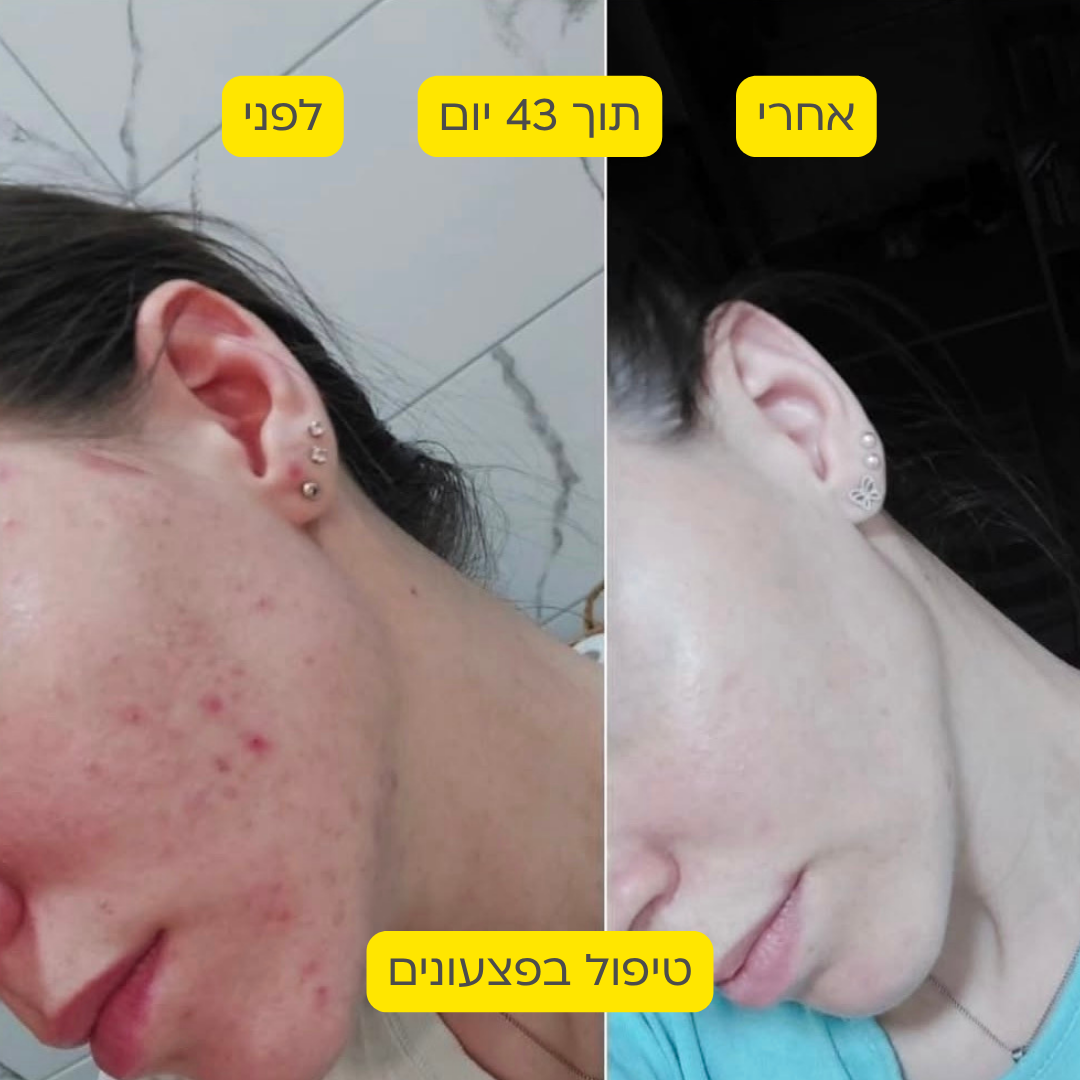 לפני אחרי 20