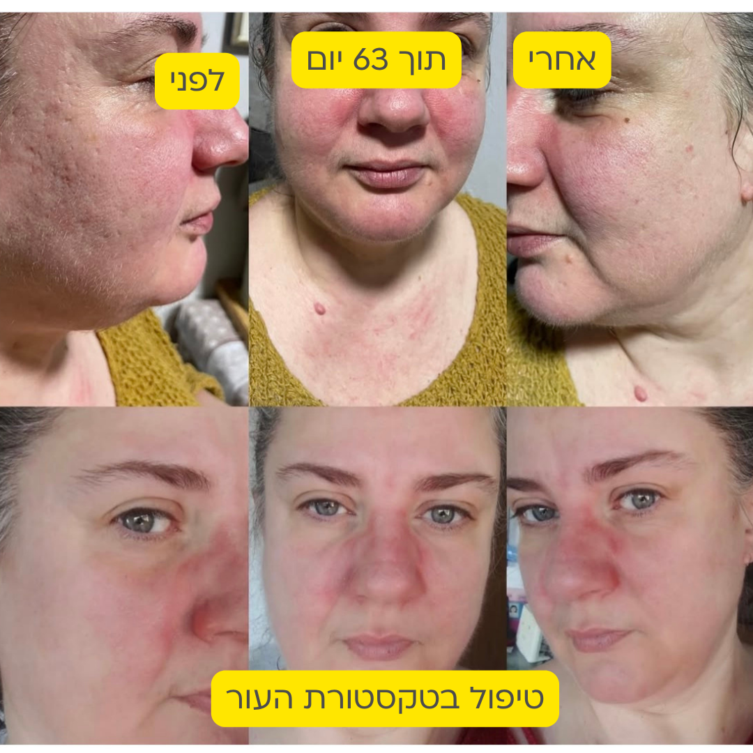 לפני אחרי 11