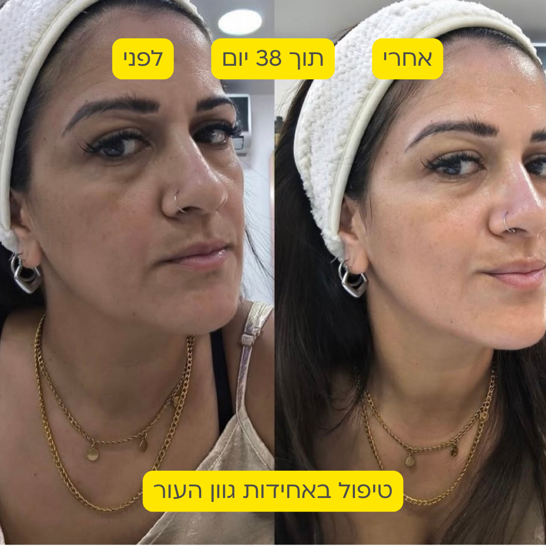 לפני אחרי 16