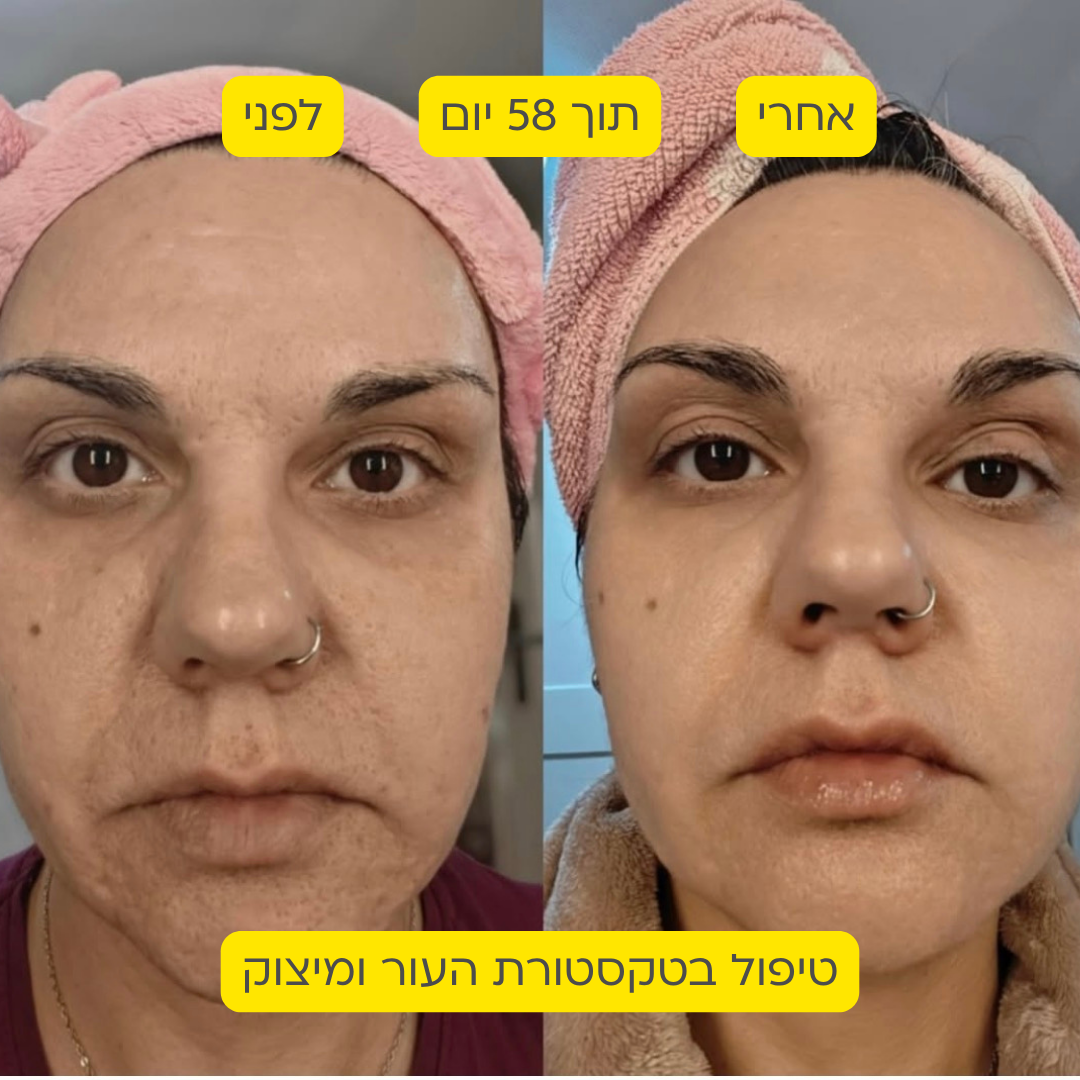 לפני אחרי 15