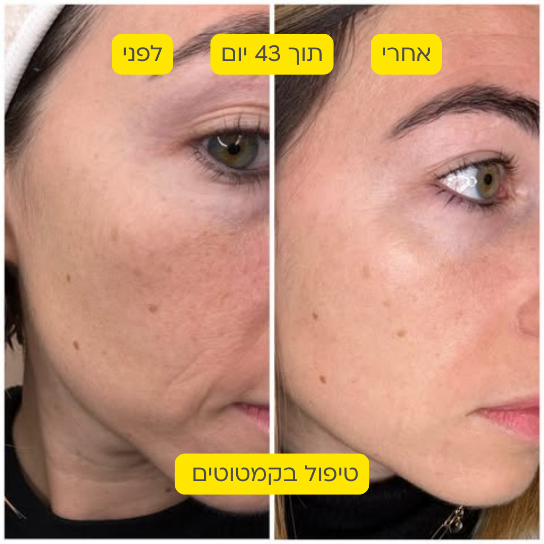 לפני אחרי 1
