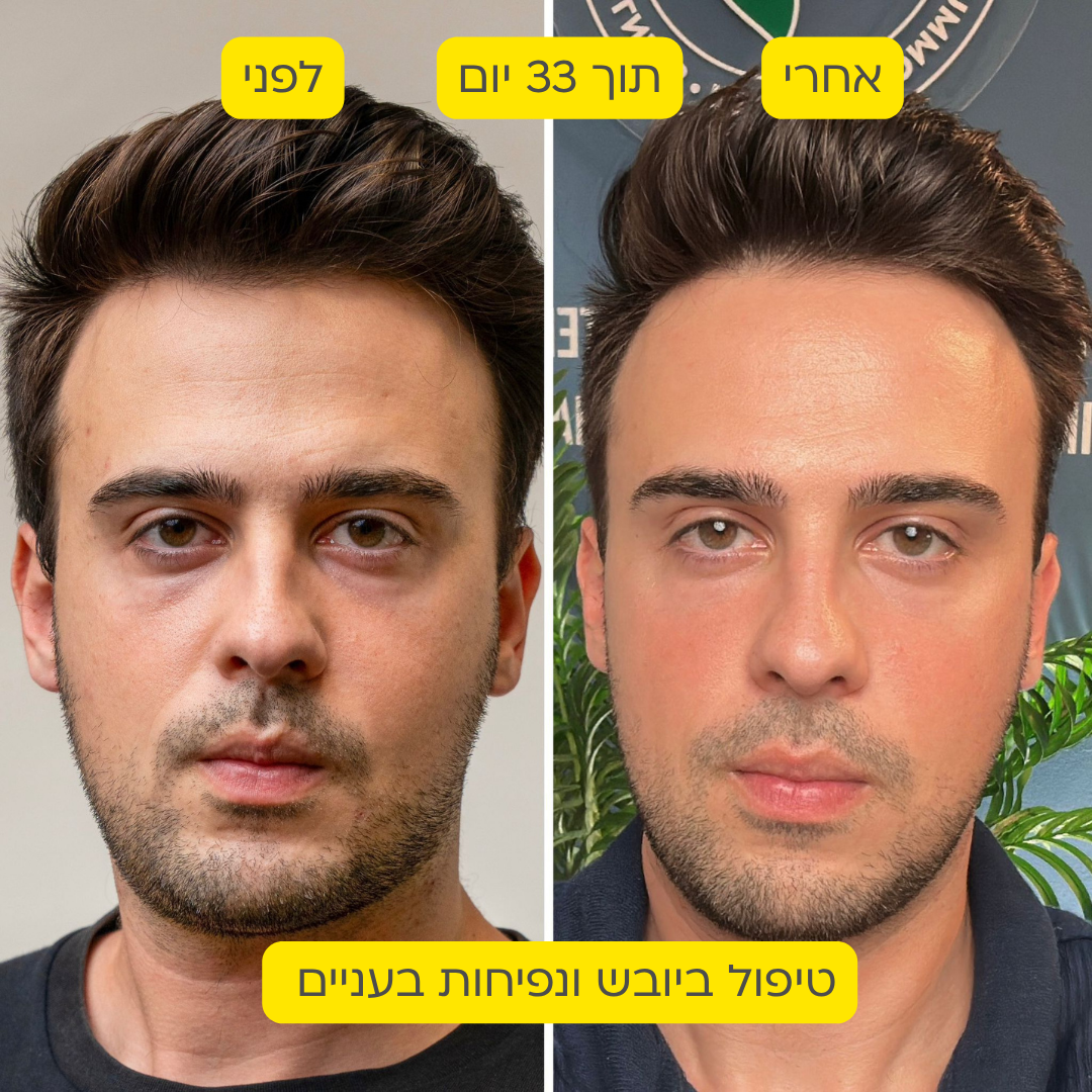 לפני אחרי 3