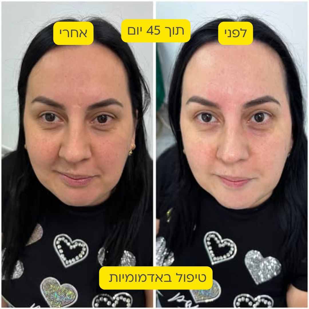 לפני אחרי 18