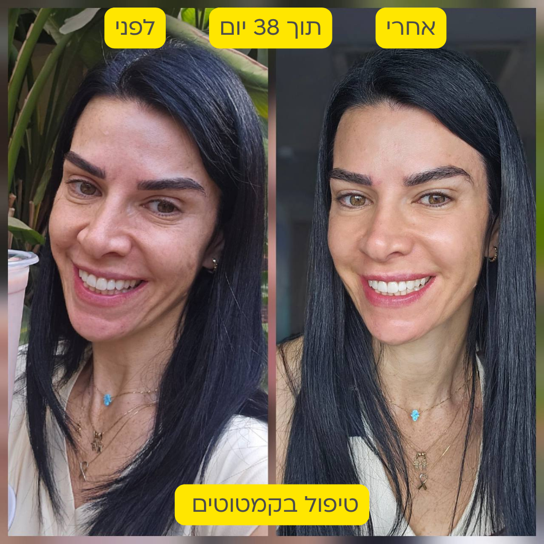 לפני אחרי 20