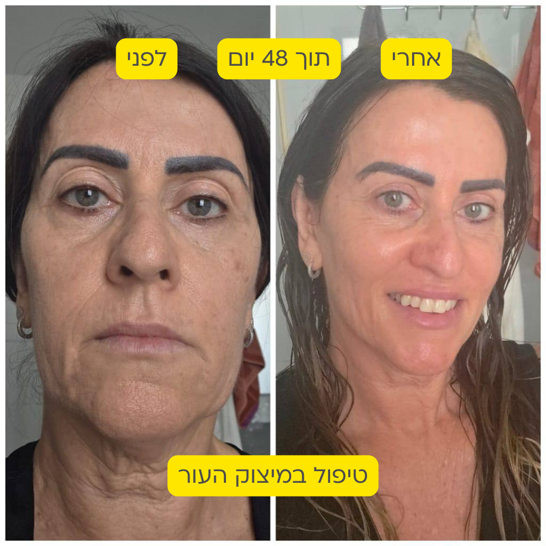 לפני אחרי 21