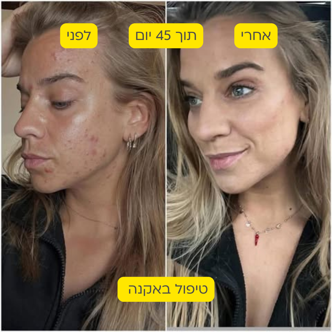 לפני אחרי 22